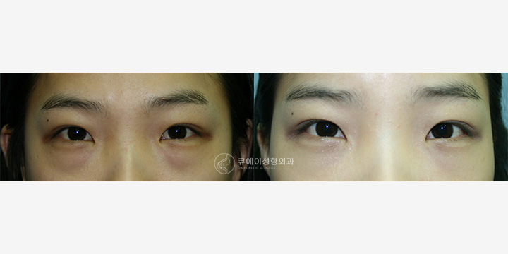 눈 밑 지방 재배치2.jpg